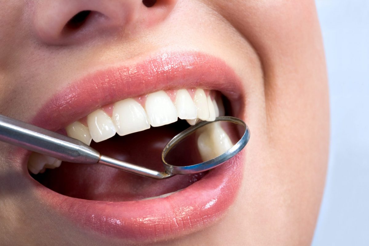 Personalised Smile Design with Porcelain Laminates woman's teeth