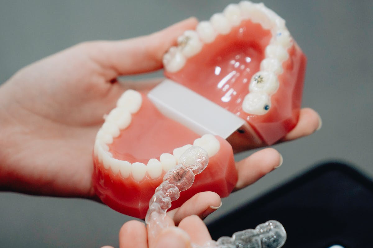 clear aligner