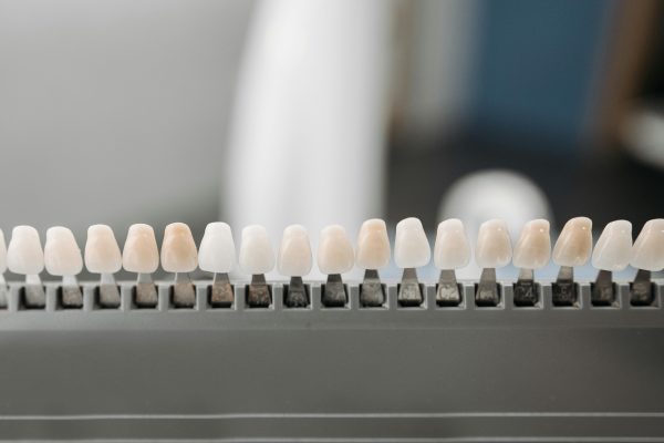 different types of veneers