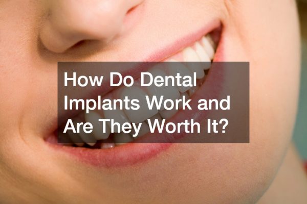 How Do Dental Implants Work and Are They Worth It?